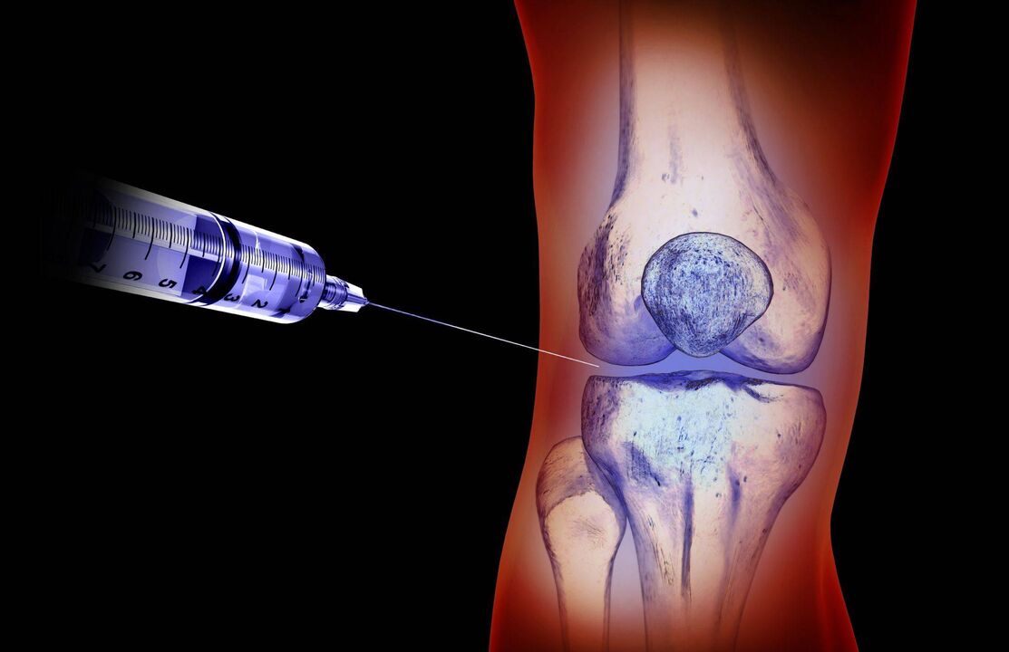 Intra-articular injection to treat arthritis