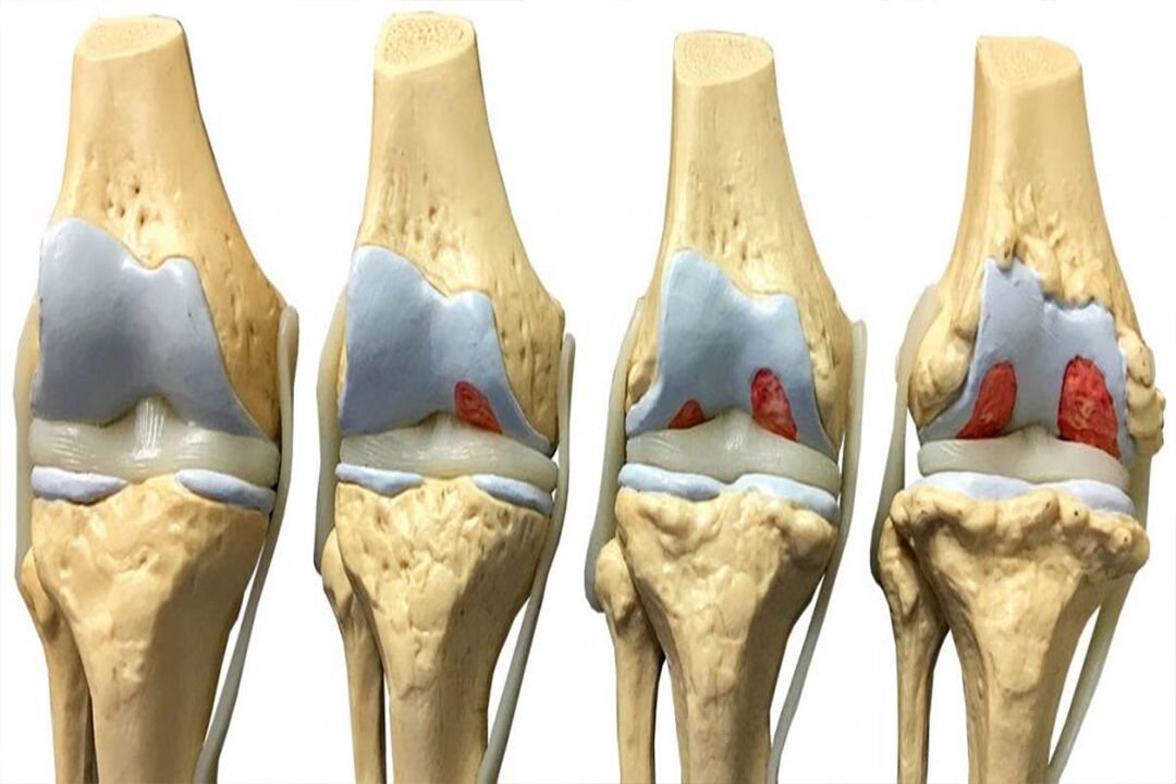 stages of development of joint disease