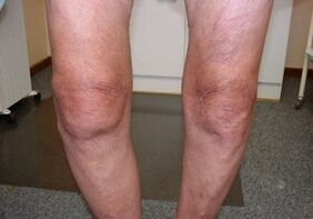 How to treat knee joint disease
