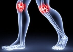 Reasons for the development of knee arthritis