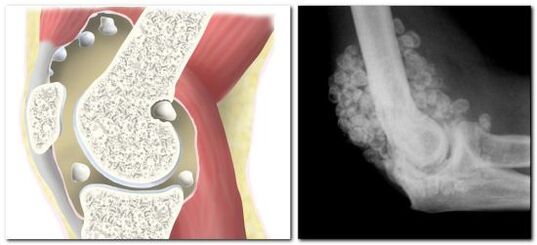 Chondromatosis with pain in the hip joint