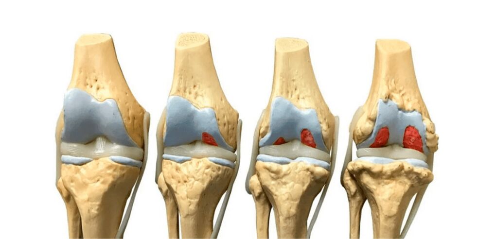 degree of arthritis of the joint